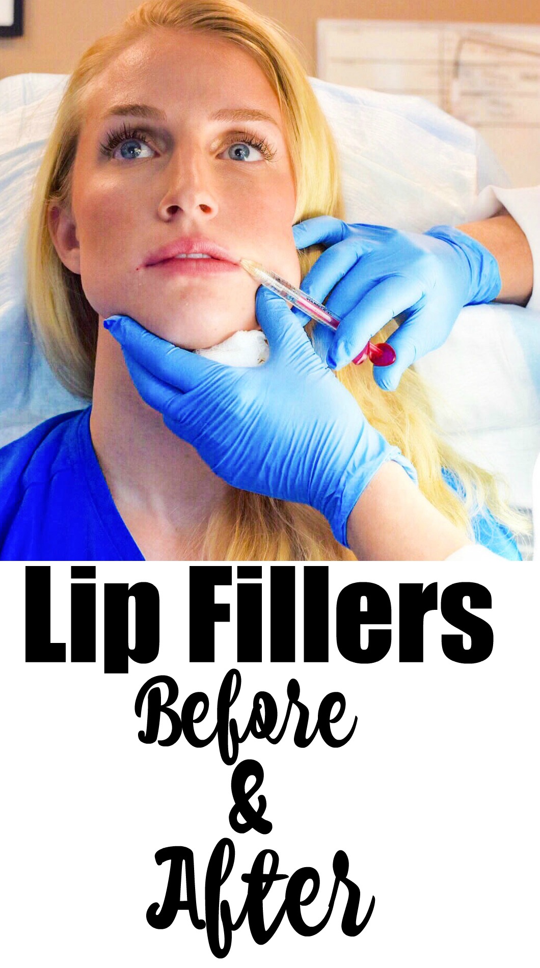 Lip Fillers Before and After #mommymakeover series by Jessica from Happily Hughes